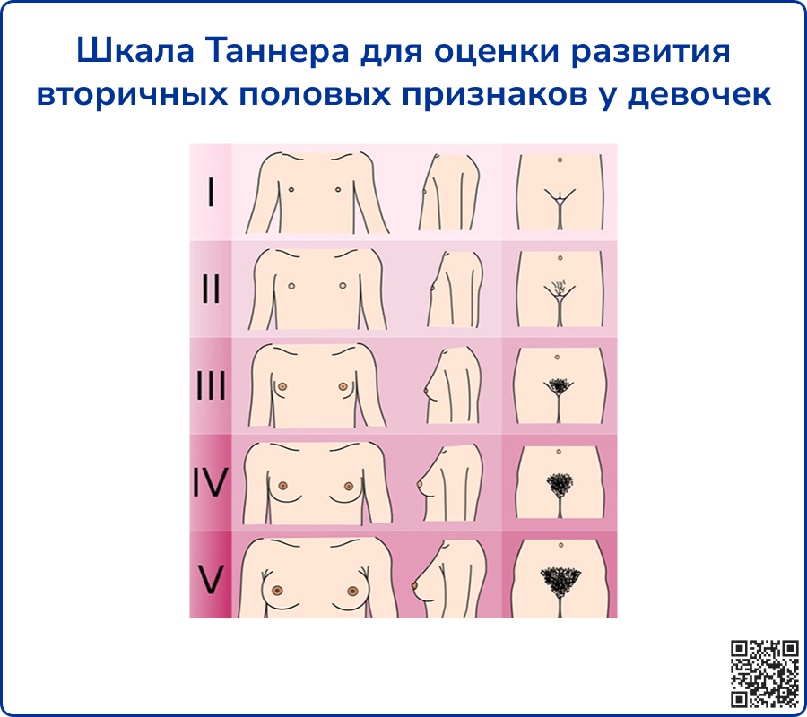 Шкала Таннера для оценки развития вторичных половых признаков у девочек
